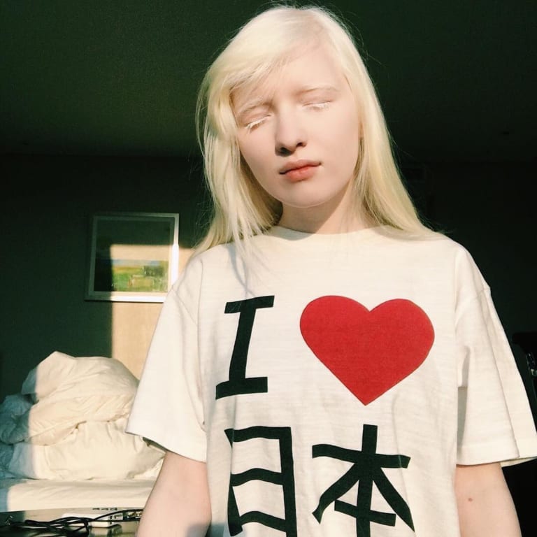 アルビノの日本人と海外の芸能人＆モデル22名～原因・遺伝・確率も総まとめ