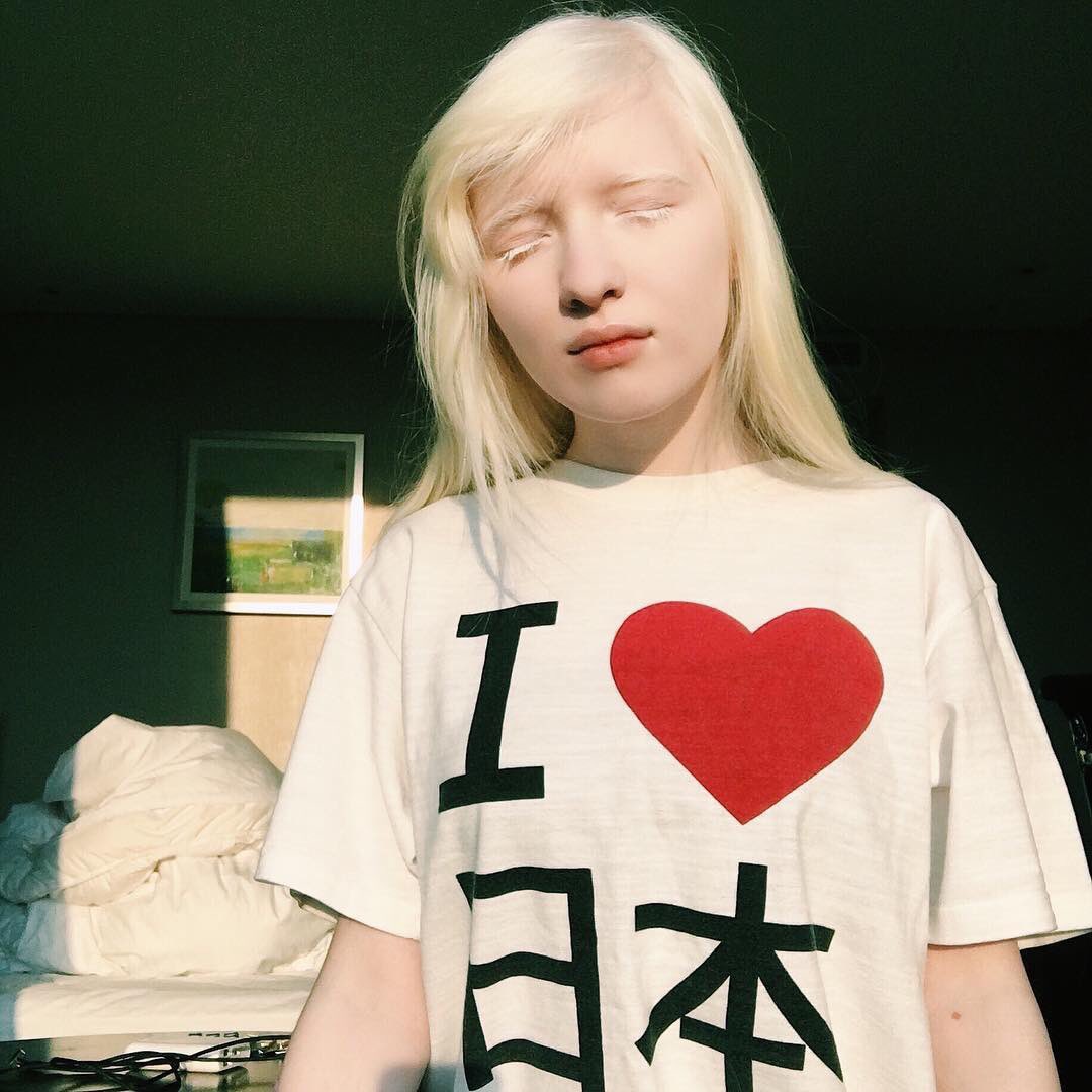 アルビノの日本人と海外の芸能人&モデル22名~原因・遺伝・確率も総まとめ