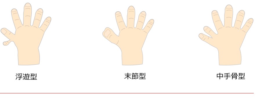多指症の芸能人/有名人16人!愛子様は?基礎知識も総まとめ【最新版】