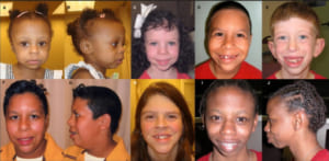 ウィリアムズ症候群の治療選択肢